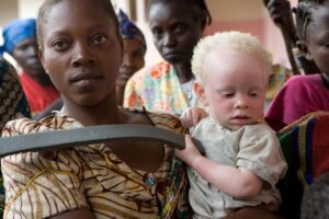 asesinatos de albinos en Africa