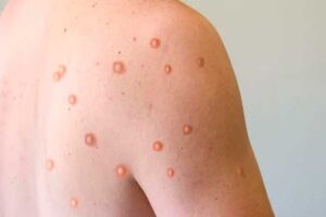 Australia-casos-viruela-símica