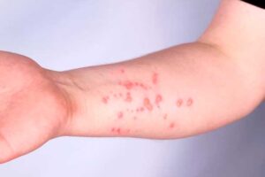 Vietnam-vigilancia-viruela-del-mono