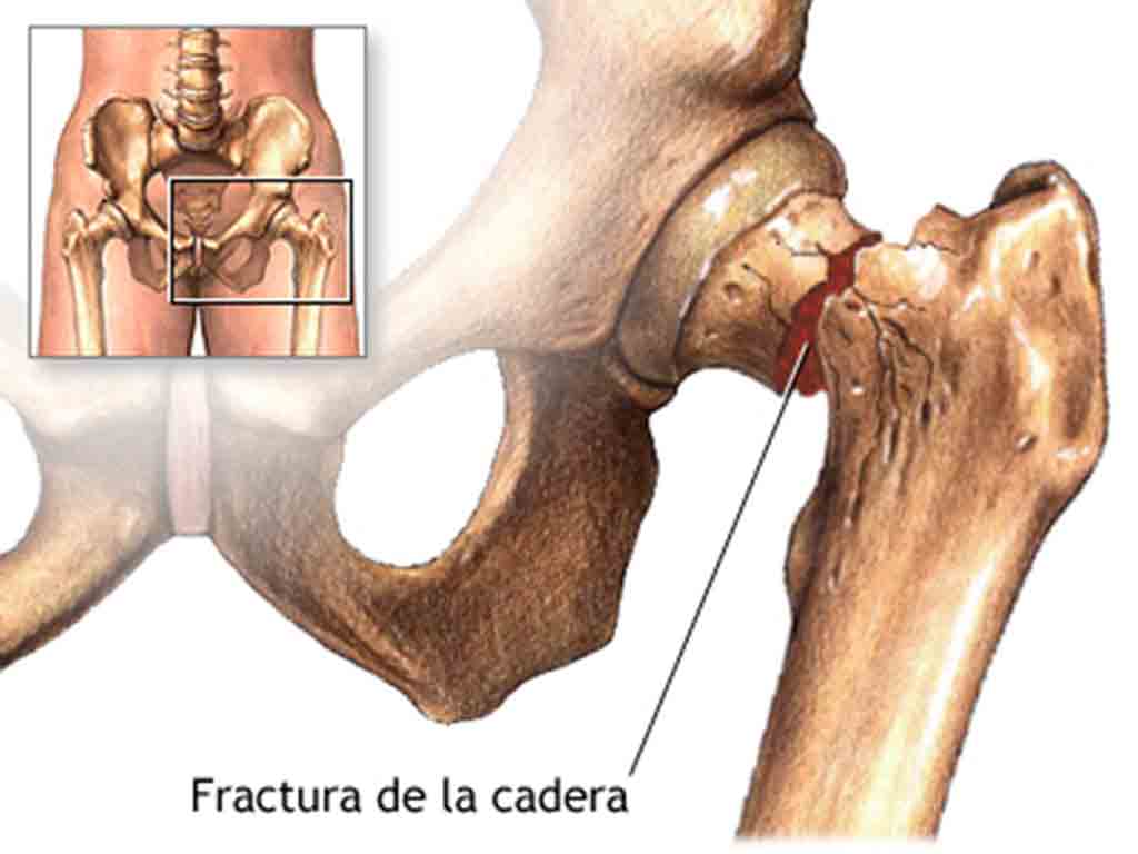 fracturas-de-cadera-seran-un-problema-a-nivel-mundial