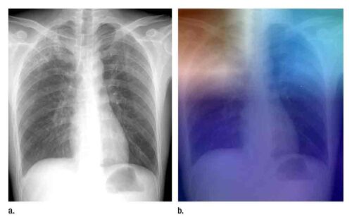inteligencia-artificial-puede-detectar-tuberculosis-en-radiografias