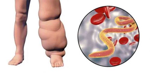 laos-elimina-la-elefantiasis-como-problema-de-salud-publica